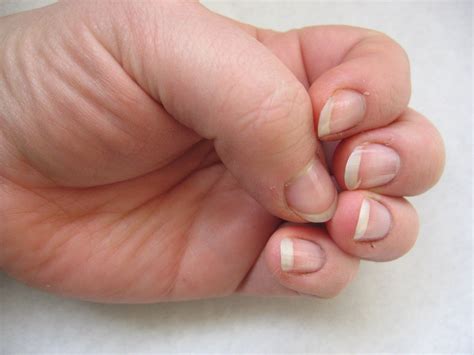 Tratamentul supurației unui deget pe o mână cu injecții osoase în diabet